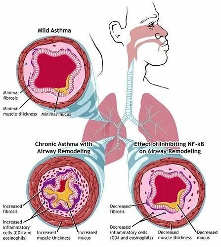 asthma3