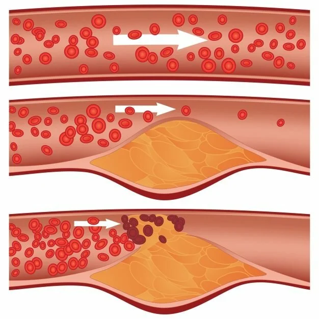 cholesterol1