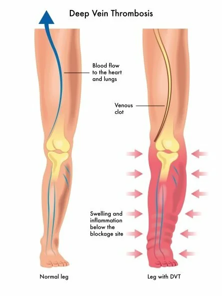 Deep Vein Thrombosis - DVT