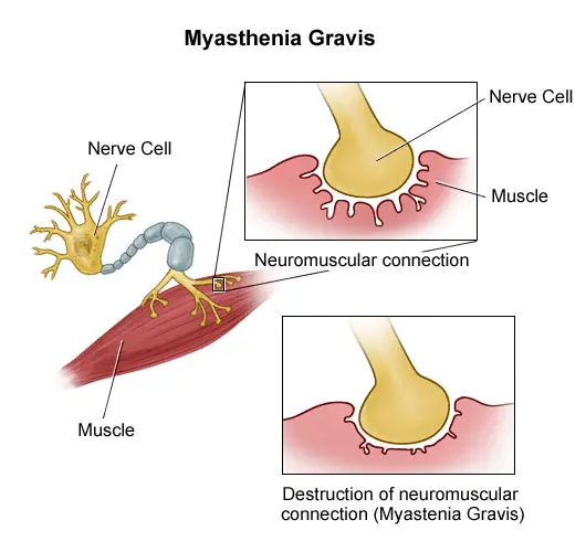 myasthenia-gravis-168639