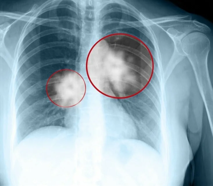 lung cancer CanadianPharmacyMeds.com