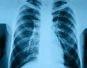 lung scan CanadianPharmacyMeds.com