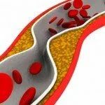 Artery with cholesterol blockage CanadianPharmacyMeds.com