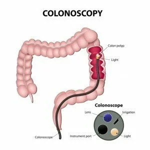 Colonoscopies can help diagnose bloody stool CanadianPharmacyMeds.com